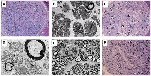Sural nerve pathology in patients with mutations in SLC52A2. Resin semi-thin sections, stained with methylene blue–azure A and basic fuchsin